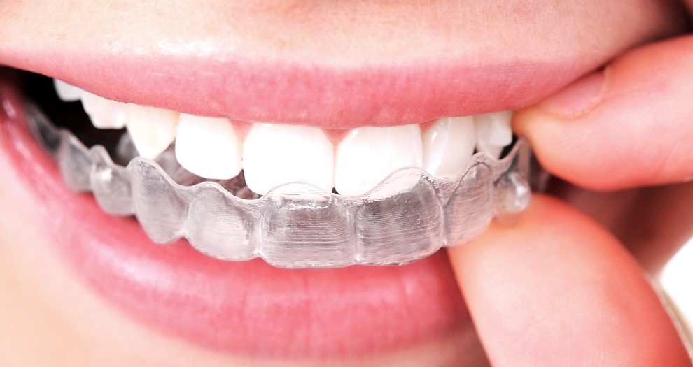 Invisalign